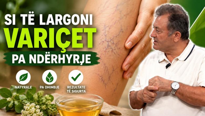  Si të largoni variçet pa ndërhyrje? Këshillat e Ylli Merjës