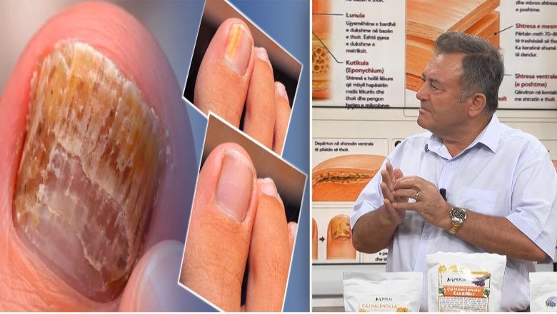 Myku i thonjve nuk largohet vetë! Ylli Merja tregon kurën natyrale më efektive